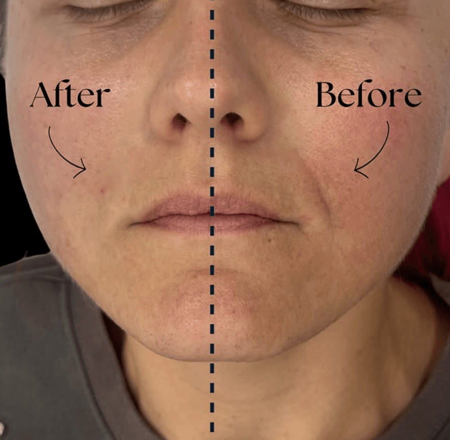 Anti-Wrinkle Treatments — 1