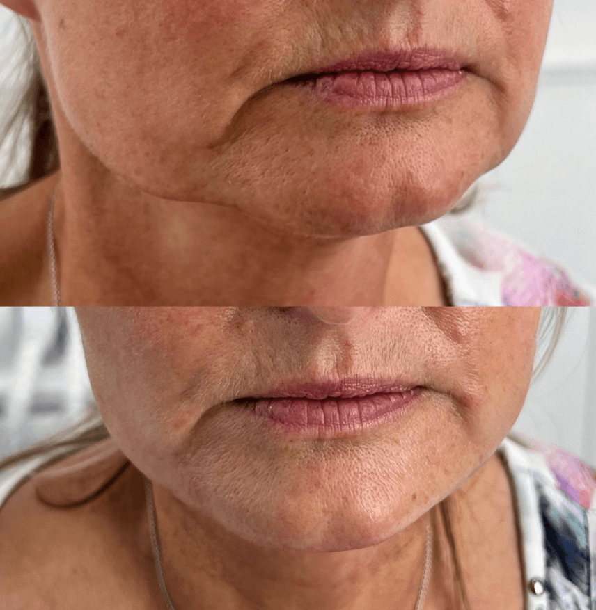 Anti-Wrinkle Treatments — 2