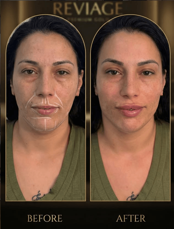 Lip Enhancement — 1