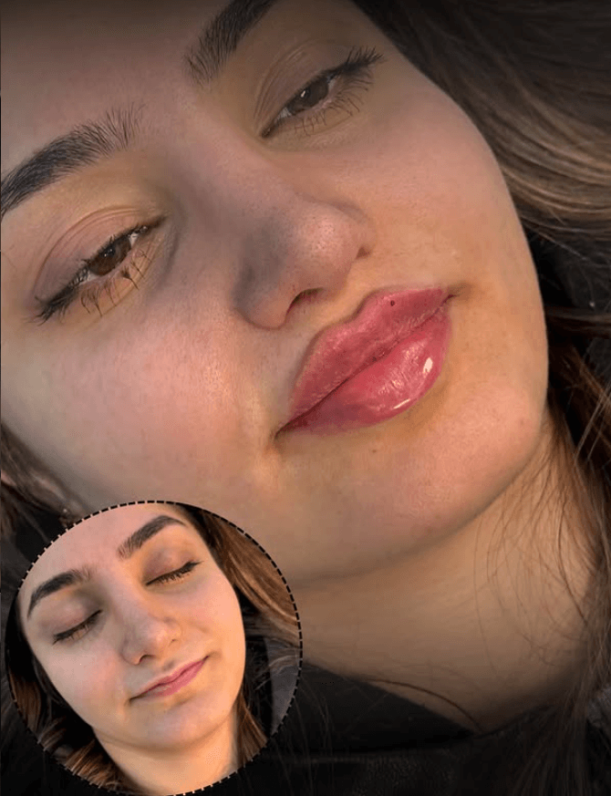 Lip Enhancement — 2