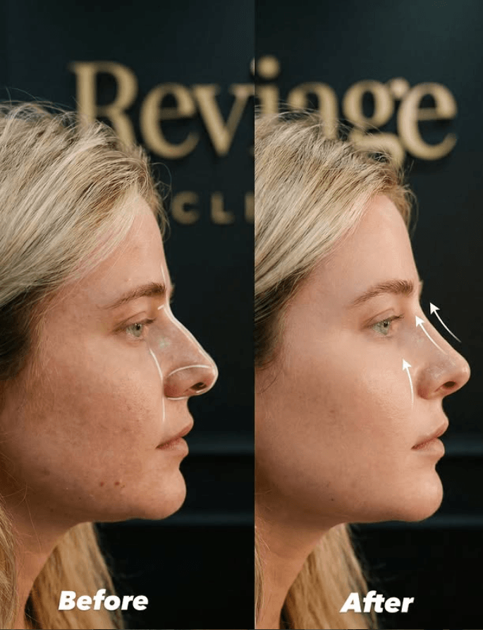 Liquid Rhinoplasty — 3